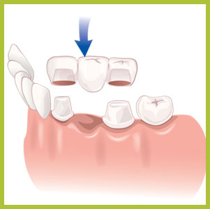 File:Austin dentist bridge.jpg