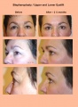 Blepharoplasty1.jpg